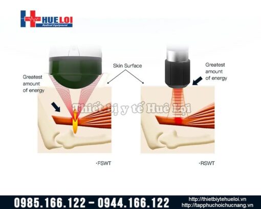 Máy xung kích hội tụ EMFocus- ElectroMagnetic Shockwave